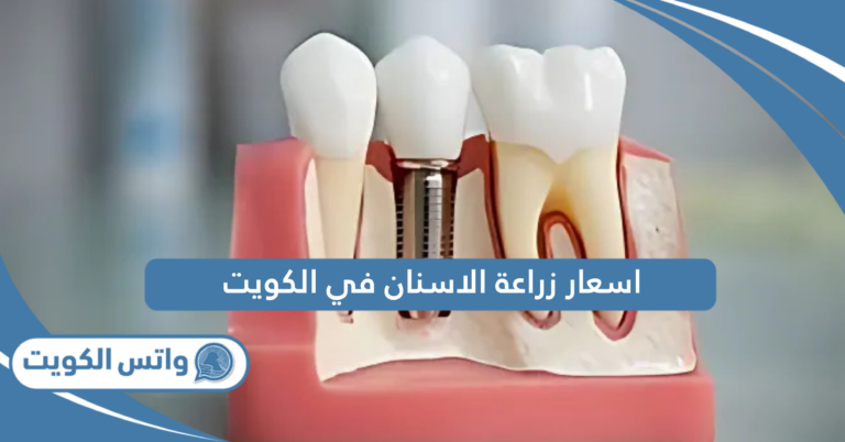 اسعار زراعة الاسنان في الكويت 2025؛ الدليل الكامل